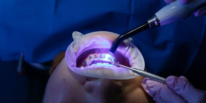 Teeth Whitening at Home vs. Professional Treatments: Costs and Results Compared